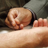 Acupuncture