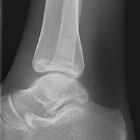 Ankle Pain