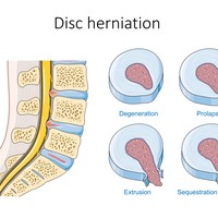 Herniated Disc
