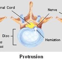 Herniated Disc