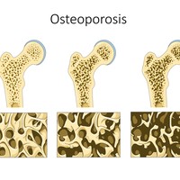 Osteoporosis