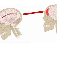 Traumatic Brain Injury